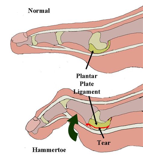 test for plantar plate tear|plantar plate injury symptoms.